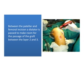 Between the patellar and
femoral incision a dialator is
passed to make room for
the passage of the graft
between the layer 2 and 3.

 
