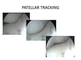 PATELLAR TRACKING

 