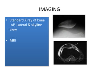 IMAGING
• Standard X ray of knee
-AP, Lateral & skyline
view
• MRI

 