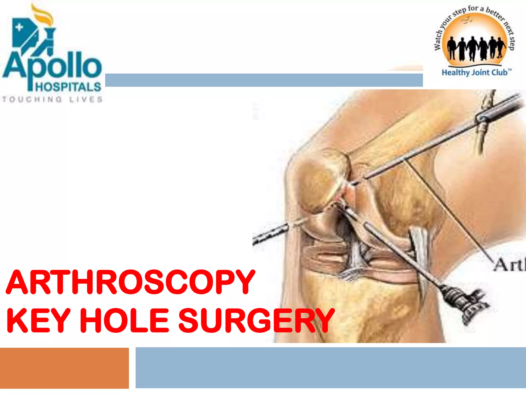 Arthroscopy key hole surgery | PPTX