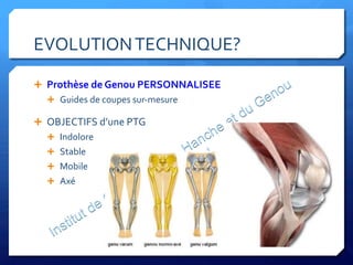 EVOLUTION	
  TECHNIQUE?	
  
Ê  Prothèse	
  de	
  Genou	
  PERSONNALISEE	
  
Ê  Guides	
  de	
  coupes	
  sur-­‐mesure	
  
Ê  OBJECTIFS	
  d’une	
  PTG	
  
Ê  Indolore	
  
Ê  Stable	
  
Ê  Mobile	
  
Ê  Axé	
  
	
  
 