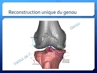 Reconstruction	
  unique	
  du	
  genou	
  	
  
 