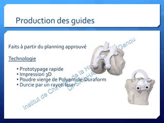 Production	
  des	
  guides	
  
Faits	
  à	
  partir	
  du	
  planning	
  approuvé	
  	
  
	
  
Technologie	
  
	
  
• 	
  Prototypage	
  rapide	
  
• 	
  Impression	
  3D	
  
• 	
  Poudre	
  vierge	
  de	
  Polyamide-­‐Duraform	
  
• 	
  Durcie	
  par	
  un	
  rayon	
  laser	
  
	
  
 