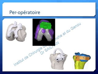 Per-­‐opératoire	
  
 