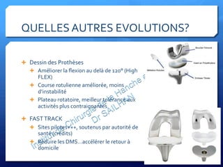 QUELLES	
  AUTRES	
  EVOLUTIONS?	
  
Ê  Dessin	
  des	
  Prothèses	
  
Ê  Améliorer	
  la	
  ﬂexion	
  au	
  delà	
  de	
  120°	
  (High	
  
FLEX)	
  
Ê  Course	
  rotulienne	
  améliorée,	
  moins	
  
d’instabilité	
  
Ê  Plateau	
  rotatoire,	
  meilleur	
  tolérance	
  aux	
  
activités	
  plus	
  contraignantes	
  
Ê  FAST	
  TRACK	
  
Ê  Sites	
  pilotes+++,	
  soutenus	
  par	
  autorité	
  de	
  
santé	
  (crédits)	
  
Ê  Réduire	
  les	
  DMS…accélérer	
  le	
  retour	
  à	
  
domicile	
  
	
  
 