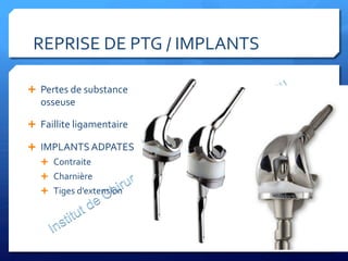 REPRISE	
  DE	
  PTG	
  /	
  IMPLANTS	
  
Ê  Pertes	
  de	
  substance	
  
osseuse	
  
Ê  Faillite	
  ligamentaire	
  
Ê  IMPLANTS	
  ADPATES	
  
Ê  Contraite	
  
Ê  Charnière	
  
Ê  Tiges	
  d’extension	
  
 