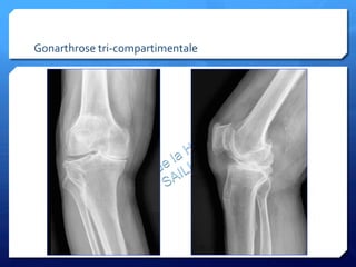 Gonarthrose	
  tri-­‐compartimentale	
  
 