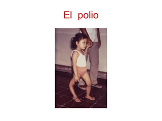 El  polio 