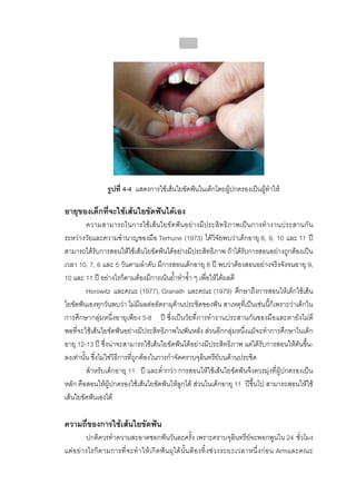 บทที่ 4 การควบคุมคราบจุลินทรียโดยวิธีกล
                                                      161




                   รูปที่ 4-4 แสดงการใชเสนใยขัดฟนในเด็กโดยผูปกครองเปนผูทาให
                                                                              ํ

อายุของเด็กที่จะใชเสนใยขัดฟนไดเอง
         ความสามารถในการใชเสนใยขัดฟนอยางมีประสิทธิภาพเปนการทํางานประสานกัน
ระหวางวัยและความชํานาญของมือ Terhune (1973) ไดวิจัยพบวาเด็กอายุ 8, 9, 10 และ 11 ป
สามารถไดรับการสอนใหใชเสนใยขัดฟนไดอยางมีประสิทธิภาพ ถาไดรับการสอนอยางถูกตองเปน
เวลา 10, 7, 6 และ 5 วันตามลําดับ มีการสอนเด็กอายุ 8 ป พบวาตองสอนอยางจริงจังจนอายุ 9,
10 และ 11 ป อยางไรก็ตามตองมีการเนนย้ําทําซ้ํา ๆ เพื่อใหไดผลดี
         Horowitz และคณะ (1977), Granath และคณะ (1979) ศึกษาถึงการสอนใหเด็กใชเสน
ใยขัดฟนเองทุกวันพบวา ไมมีผลตออัตราผุดานประชิดของฟน สาเหตุที่เปนเชนนี้ก็เพราะวาเด็กใน
การศึกษากลุมหนึ่งอายุเพียง 5-8 ป ซึ่งเปนวัยที่การทํางานประสานกันของมือและตายังไมดี
พอที่จะใชเสนใยขัดฟนอยางมีประสิทธิภาพในฟนหลัง สวนอีกกลุมหนึ่งแมจะทําการศึกษาในเด็ก
อายุ 12-13 ป ซึ่งนาจะสามารถใชเสนใยขัดฟนไดอยางมีประสิทธิภาพ แตไดรับการสอนใหดันขึ้น-
ลงเทานั้น ซึ่งไมใชวิธีการที่ถูกตองในการกําจัดคราบจุลินทรียบนดานประชิด
         สําหรับเด็กอายุ 11 ป และต่ํากวา การสอนใหใชเสนใยขัดฟนจึงควรมุงที่ผูปกครองเปน
หลัก คือสอนใหผูปกครองใชเสนใยขัดฟนใหลูกได สวนในเด็กอายุ 11 ปขึ้นไป สามารถสอนใหใช
เสนใยขัดฟนเองได

ความถี่ของการใชเสนใยขัดฟน
           ปกติควรทําความสะอาดซอกฟนวันละครั้ง เพราะคราบจุลินทรียจะพอกพูนใน 24 ชั่วโมง
แต อ ย า งไรก็ ต ามการที่ จ ะทํ า ให เ กิ ด ฟ น ผุ ไ ด นั้น ต อ งทิ้ ง ช ว งระยะเวลาหนึ่ ง ก อ น Armและคณะ
 