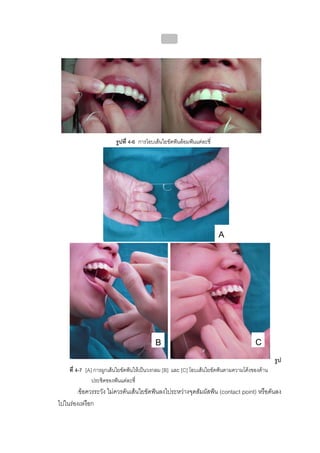บทที่ 4 การควบคุมคราบจุลินทรียโดยวิธีกล
                                                163




                         รูปที่ 4-6 การโอบเสนใยขัดฟนลอมฟนแตละซี่




                                                                        A




                                           B                                          C
                                                                                               รูป
    ที่ 4-7 [A] การผูกเสนใยขัดฟนใหเปนวงกลม [B] และ [C] โอบเสนใยขัดฟนตามความโคงของดาน
               ประชิดของฟนแตละซี่
       ขอควรระวัง   ไมควรดันเสนใยขัดฟนลงไประหวางจุดสัมผัสฟน (contact point) หรือดันลง
ไปในรองเหงือก
 