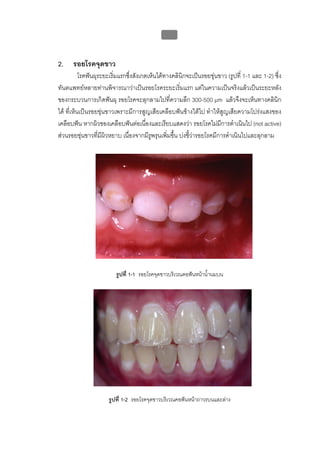 บทที่ 1 โรคฟนผุ
                                                  9


2.    รอยโรคจุดขาว
           โรคฟนผุระยะเริ่มแรกซึ่งสังเกตเห็นไดทางคลินิกจะเปนรอยขุนขาว (รูปที่ 1-1 และ 1-2) ซึ่ง
ทันตแพทยหลายทานพิจารณาวาเปนรอยโรคระยะเริ่มแรก แตในความเปนจริงแลวเปนระยะหลัง
ของกระบวนการเกิดฟนผุ รอยโรคจะลุกลามไปที่ความลึก 300-500 μm แลวจึงจะเห็นทางคลินิก
ได ที่เห็นเปนรอยขุนขาวเพราะมีการสูญเสียเคลือบฟนขางใตไป ทําใหสูญเสียความโปรงแสงของ
เคลือบฟน หากผิวของเคลือบฟนตอเนื่องและเรียบแสดงวา รอยโรคไมมีการดําเนินไป (not active)
สวนรอยขุนขาวที่มีผิวหยาบ เนื่องจากมีรูพรุนเพิ่มขึ้น บงชี้วารอยโรคมีการดําเนินไปและลุกลาม




                         รูปที่ 1-1 รอยโรคจุดขาวบริเวณคอฟนหนาน้ํานมบน




                      รูปที่ 1-2 รอยโรคจุดขาวบริเวณคอฟนหนาถาวรบนและลาง
 