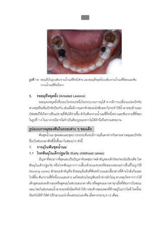 บทที่ 1 โรคฟนผุ
                                                       11




รูปที่ 1-4 รอยผุที่เปนรูบนฟนกรามน้ํานมซี่ที่หนึ่งซาย และรอยผุที่หยุดยั้งบนฟนกรามน้ํานมซี่ที่สองและฟน
           กรามน้ํานมซี่ที่หนึ่งขวา

5.     รอยผุที่หยุดยั้ง (Arrested Lesions)
         รอยผุจะหยุดยั้งที่ระยะใดระยะหนึ่งในกระบวนการผุได หากมีการเปลี่ยนแปลงปจจัย
สาเหตุหรือเพิ่มปจจัยปองกัน เชนเมื่อมีการแตกหักของผนังฟนออกไปจะทําใหน้ําลายชะลางและ
บัฟเฟอรใหเกิดการคืนแรธาตุที่ฟนไดงายขึ้น ดังในฟนกรามน้ํานมซี่ที่หนึ่งขวาและฟนกรามซี่ที่สอง
ในรูปที่ 1-4 ในบางกรณีอาจไมจําเปนตองบูรณะหากไมไดคํานึงถึงความสวยงาม

รูปแบบการผุของฟนในระยะตาง ๆ ของเด็ก
        ฟนชุดน้ํานม ชุดผสมและชุดถาวรระยะตนจะมีการผุที่แตกตางกันตามสาเหตุและปจจัย
อื่นๆในชวงเวลาฟนซี่นั้นขึ้นมาในชองปาก ดังนี้
1. การผุในฟนชุดน้ํานม
1.1 โรคฟนผุในเด็กปฐมวัย (Early childhood caries)
           ปญหาที่พบมากที่สุดและเปนปญหาทันตสุขภาพสําคัญของเด็กไทยกอนวัยเรียนคือ โรค
ฟ น ผุ ใ นเด็ ก ปฐมวั ย หรื อ โรคฟ น ผุ จ ากการเลี้ ย งด ว ยนมขวดหรื อ ของเหลวอย า งอื่ น ที่ ไ ม ถู ก วิ ธี
(Nursing caries) ลักษณะสําคัญคือ มีรอยผุเริ่มตนที่ฟนหนาบนและเขี้ยวลางที่ดานใกลแกมและ
ใกลลิ้น ฟนกรามซี่ที่หนึ่งบนและลาง แตโดยสวนใหญฟนหนาลางมักไมผุ สาเหตุเกิดจากการให
เด็กดูดนมขวดเขานอนหรือดูดนมในชวงนอนกลางคืน หรือดูดนมมารดาทุกเมื่อที่ตองการในขณะ
นอน โดยในชวงนอนน้ําลายจะหลั่งนอยจึงทําใหการชะลางของเหลวที่คางอยูในปากไมดี โรคนี้จะ
ปองกันไดถาใหคําปรึกษาแนะนําตั้งแตระยะแรกคือ เมื่อทารกอายุ 6-12 เดือน
 