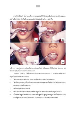 ทันตกรรมป้องกันในเด็กและวัยรุ่น 