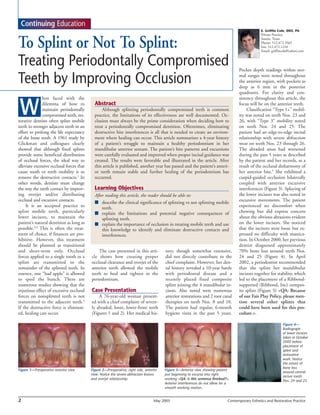 Continuing Education
                                                                                                                                                    E. Griffin Cole, DDS, PA
                                                                                                                                                    Private Practice


To Splint or Not To Splint:                                                                                                                         Austin, Texas
                                                                                                                                                    Phone: 512.472.3565
                                                                                                                                                    Fax: 512.472.1210
                                                                                                                                                    Email: griffincole@yahoo.com


Treating Periodontally Compromised                                                                                                    Pocket depth readings within nor-

Teeth by Improving Occlusion                                                                                                          mal ranges were noted throughout
                                                                                                                                      the anterior region, with pockets as
                                                                                                                                      deep as 6 mm in the posterior
                                                                                                                                      quadrants. For clarity and con-
              hen faced with the                                                                                                      sistency throughout this article, the


 W            dilemma of how to
              maintain periodontally
              compromised teeth, res-
torative dentists often splint mobile
                                             Abstract
                                                 Although splinting periodontally compromised teeth is common
                                             practice, the limitations of its effectiveness are well documented. Oc-
                                             clusion must always be the prime consideration when deciding how to
                                                                                                                                      focus will be on the anterior teeth.
                                                                                                                                           Classification “Type 1+” mobil-
                                                                                                                                      ity was noted on teeth Nos. 23 and
                                                                                                                                      26, with “Type 3” mobility noted
teeth to stronger adjacent teeth in an       treat a periodontally compromised dentition. Oftentimes, eliminating                     on teeth Nos. 24 and 25. The
effort to prolong the life expectancy        destructive bite interferences is all that is needed to create an environ-               patient had an edge-to-edge incisal
of the loose teeth. A 1961 study by          ment where healing can occur. This article summarizes a 4-year history                   relationship with severe abfraction
Glickman and colleagues clearly              of a patient’s struggle to maintain a healthy periodontium in her                        wear on teeth Nos. 23 through 26.
showed that although fixed splints           mandibular anterior sextant. The patient’s bite patterns and excursions                  The abraded areas had worsened
provide some beneficial distribution         were carefully evaluated and improved when proper incisal guidance was                   during the past 5 years as described
of occlusal forces, the ideal way to         created. The results were favorable and illustrated in the article. After                by the patient and her records, as a
alleviate excessive occlusal forces that     this article is published, another year has passed and the patient’s anteri-             result of the occlusal disharmony of
cause tooth or teeth mobility is to          or teeth remain stable and further healing of the periodontium has                       her anterior bite.5 She exhibited a
remove the destructive contacts.1 In         occurred.                                                                                cuspid-guided occlusion bilaterally
other words, dentists must change                                                                                                     coupled with anterior excursive
the way the teeth contact by improv-         Learning Objectives                                                                      interferences (Figure 3). Splaying of
ing overjet and/or distributing              After reading this article, the reader should be able to:                                the lower incisors was also noted in
occlusal and excursive contacts.             ■ describe the clinical significance of splinting vs not splinting mobile                excursive movements. The patient
     It is an accepted practice to               teeth.                                                                               experienced no discomfort when
splint mobile teeth, particularly            ■ explain the limitations and potential negative consequences of                         chewing but did express concern
lower incisors, to maintain the                  splinting teeth.                                                                     about the obvious abrasions evident
patient’s natural dentition as long as       ■ explain the importance of occlusion in treating mobile teeth and use                   on the lower incisors. She noticed
possible.2,3 This is often the treat-            this knowledge to identify and eliminate destructive contacts and                    that the incisors were loose but ex-
ment of choice, if finances are pro-             interferences.                                                                       pressed no difficulty with mastica-
hibitive. However, this treatment                                                                                                     tion. In October 2000, her previous
should be planned as transitional                                                                                                     dentist diagnosed approximately
and short-term only. Occlusal                  The case presented in this arti-          tory, though somewhat extensive,             70% bone loss around teeth Nos.
forces applied to a single tooth in a      cle shows how creating proper                 did not directly contribute to the           24 and 25 (Figure 4). In April
splint are transmitted to the              occlusal clearance and overjet of the         chief complaint. However, her den-           2002, a periodontist recommended
remainder of the splinted teeth. In        anterior teeth allowed the mobile             tal history revealed a 10-year battle        that she splint her mandibular
essence, one “bad apple” is allowed        teeth to heal and tighten in the              with periodontal disease and a               incisors together for stability, which
to spoil the bunch. There are              periodontium.                                 recently placed fixed composite              led to the placement of a Ribbond-
numerous studies showing that the                                                        splint joining the 4 mandibular in-          supported (Ribbond, Inc) compos-
injurious effect of excessive occlusal     Case Presentation                             cisors. Also noted were numerous             ite splint (Figure 5) <QA: Because
forces on nonsplinted teeth is not             A 76-year-old woman present-              anterior restorations and 2 root canal       of our Fair Play Policy, please men-
transmitted to the adjacent teeth.4        ed with a chief complaint of severe-          therapies on teeth Nos. 8 and 10.            tion several other splints that
If the destructive force is eliminat-      ly abraded, loose, lower-front teeth          The patient had regular, 6-month             could have been used for this pro-
ed, healing can occur.                     (Figures 1 and 2). Her medical his-           hygiene visits in the past 5 years.          cedure.>.

                                                                                                                                                                  Figure 4—
                                                                                                                                                                  Radiograph
                                                                                                                                                                  of lower incisors
                                                                                                                                                                  taken in October
                                                                                                                                                                  2000 before
                                                                                                                                                                  placement of
                                                                                                                                                                  splint and
                                                                                                                                                                  restorative
                                                                                                                                                                  work. Notice
                                                                                                                                                                  the extent of
                                                                                                                                                                  bone loss
Figure 1—Preoperative anterior view.       Figure 2—Preoperative, right side, anterior   Figure 3—Anterior view showing patient
                                                                                                                                                                  around central
                                           view. Notice the severe abfraction lesions    just beginning to excurse into right
                                                                                                                                                                  incisor tooth
                                           and overjet relationship.                     working <QA: is this sentence finished?>.
                                                                                                                                                                  Nos. 24 and 25.
                                                                                         Anterior interferences do not allow for a
                                                                                         smooth working motion.


2                                                                                  May 2005                                     Contemporary Esthetics and Restorative Practice
 