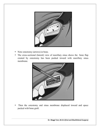  
Dr.	
  Maggi	
  Tom,	
  M.D.S	
  (Oral	
  and	
  Maxillofacial	
  Surgery)	
  
	
  
	
  
	
  
• Note osteotomy (arrows) in bone.
• The cross-sectional (lateral) view of maxillary sinus shows the bone flap
created by osteotomy has been pushed inward with maxillary sinus
membrane.
	
  
	
  
• Then the osteotomy and sinus membrane displaced inward and space
packed with bone graft.
 