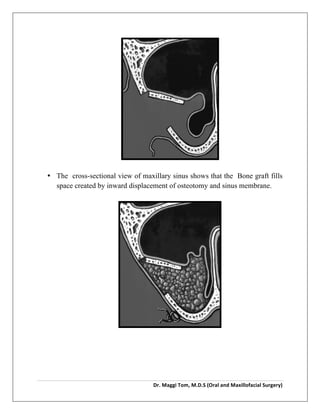  
Dr.	
  Maggi	
  Tom,	
  M.D.S	
  (Oral	
  and	
  Maxillofacial	
  Surgery)	
  
	
  
	
  
	
  
• The cross-sectional view of maxillary sinus shows that the Bone graft fills
space created by inward displacement of osteotomy and sinus membrane.
	
  
	
  
 