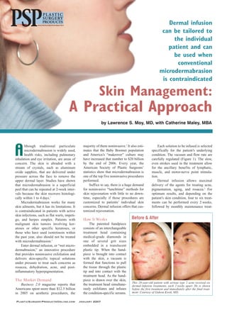 Dermal infusion
                                                                                                            can be tailored to
                                                                                                                 the individual
                                                                                                               patient and can
                                                                                                                 be used when
                                                                                                                  conventional
                                                                                                           microdermabrasion
                                                                                                            is contraindicated

                                                             Skin Management:
                                        A Practical Approach
                                                               by Lawrence S. Moy, MD, with Catherine Maley, MBA




A
       lthough traditional particulate            majority of them noninvasive.3 It also esti-           Each solution to be infused is selected
       microdermabrasion is widely used,          mates that the Baby Boomer population              specifically for the patient’s underlying
       health risks, including pulmonary          and America’s “makeover” culture may               condition. The vacuum and flow rate are
inhalation and eye irritation, are areas of       have increased that number to $20 billion          carefully regulated (Figure 1). The slow,
concern. The skin is abraded with a               by the end of 2006. Every year, the                even strokes used in the treatment allow
stream of crystals, such as aluminum              American Society of Plastic Surgeons’              for the ancillary benefits of lymphatic,
oxide sapphire, that are delivered under          statistics show that microdermabrasion is          muscle, and motor-nerve point stimula-
pressure across the face to remove the            one of the top five noninvasive procedures         tion.
upper dermal layer. Studies have shown            performed.                                             Dermal infusion allows maximal
that microdermabrasion is a superficial                Suffice to say, there is a huge demand        delivery of the agents for treating acne,
peel that can be repeated at 2-week inter-        for noninvasive “lunchtime” methods for            pigmentation, aging, and rosacea.2 For
vals because the skin recovers histologi-         skin rejuvenation with little to no down-          optimum results, and depending on the
cally within 1 to 4 days.1                        time, especially if those procedures are           patient’s skin condition, four to six treat-
    Microdermabrasion works for many              customized to patients’ individual skin            ments can be performed every 2 weeks,
skin ailments, but it has its limitations. It     concerns. Dermal infusion offers that cus-         followed by monthly maintenance treat-
is contraindicated in patients with active        tomized rejuvenation.
skin infections, such as flat warts, impeti-
go, and herpes simplex. Patients with             How It Wo rks                      Before & After
malignant skin tumors involving ker-                  The patented handpiece
atoses or other specific keratoses, or            consists of an interchangeable
those who have used isotretinoin within           treatment head containing
the past year, also should not be treated         medical-grade diamonds in
with microdermabrasion.2                          one of several grit sizes
    Enter dermal infusion, or “wet micro-         embedded in a translucent
dermabrasion,” an innovative procedure            plastic tip. When the hand-
that provides noninvasive exfoliation and         piece is brought into contact
delivers skin-specific topical solutions          with the skin, a vacuum is
under pressure to treat such concerns as          formed that functions to pull
rosacea, dehydration, acne, and post-             the tissue through the plastic
inflammatory hyperpigmentation.                   tip and into contact with the
                                                  treatment head. As the hand-
The Market Demand                                 piece is drawn over the skin,
                                                                                     This 20-year-old patient with serious type 2 acne received six
   Business 2.0 magazine reports that             the treatment head simultane-      dermal-infusion treatments, each 2 weeks apart. He is shown
Americans spent more than $12.5 billion           ously exfoliates and infuses       before the first treatment and immediately after the final treat-
in 2005 on aesthetic procedures, the              the condition-specific serums.     ment. Courtesy of Gideon Kwok, MD.


PlasticSurgeryProductsOnline.com                January 2007
 