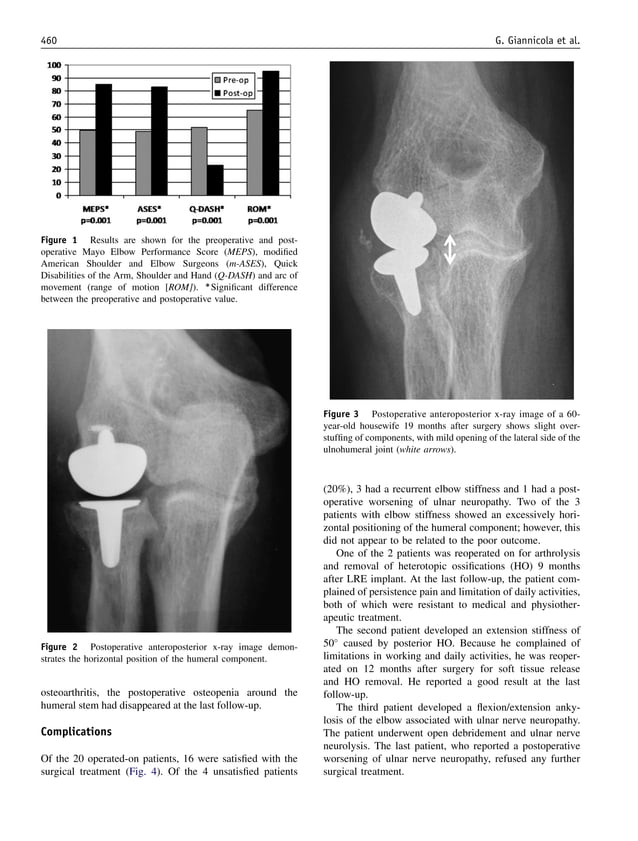 Open debridement and radiocapitellar replacement in primary and post