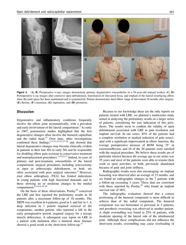 Open debridement and radiocapitellar replacement in primary and post