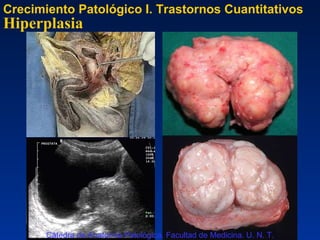 Hiperplasia Crecimiento Patológico I. Trastornos Cuantitativos Cátedra de Anatomía Patológica. Facultad de Medicina. U. N. T. 