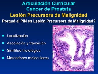 Porqué el PIN es Lesión Precursora de Malignidad? Localización  Asociación y transición Similitud histológica Marcadores moleculares Articulación Curricular Cancer de Prostata Lesión Precursora de Malignidad 