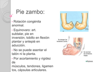  Tendones del tercer peroneo: base del 5to metatarsiano.Casos clínicos.