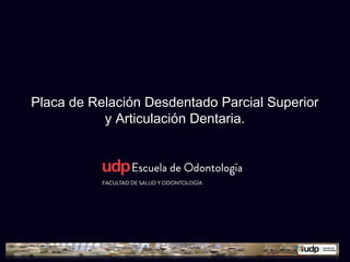 Placa de Relación Desdentado Parcial Superior
y Articulación Dentaria.
 