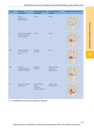 117
Clasificación de la necrosis del semilunar (enfermedad de Kienböck) según Lichtmann y Ross
7
Articulacióndelamuñecaylamano
Fig. 7.13 Clasificación de la necrosis del semilunar de Lichtmann.
07-Articulación de la muñeca y la mano:Maquetación 1 04/06/13 12:35 Página 117
Métodos de Medición y Clasificación en Radiología Musculoesquelética. ©2013. Editorial Médica Panamericana.
 
