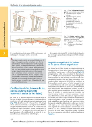 120
Clasificación de las lesiones de las poleas anulares
7
Articulacióndelamuñecaylamano
Fig. 7.15a-c Tangente metacar-
piana. Representación esquemática.
a Signo metacarpiano negativo
(normal).
b Signo metacarpiano positivo
(patológico). El signo
metacarpiano positivo se
considera como un indicio
de una alteración del desarrollo
metacarpiano.
c Situación límite
(¿normal o patológico?).
Fig. 7.16 Poleas anulares (liga-
mento transversal anular) A1-A5.
Representación esquemática.
FDP = Tendón del m. flexor digital
profundo.
FDS = Tendón del m. flexor digital
superficial.
(y es patológico) cuando la cabeza del 3er metacarpiano está
cortada por la línea (signo positivo tangencial).
Clasificación de las lesiones de las
poleas anulares (ligamento
transversal anular de los dedos)
Las vainas de los tendones de los músculos flexores están re-
forzadas por tejido conjuntivo (ligamentos o poleas anulares y
cruciformes) en la lado palmar, directamente ajustado al hueso
(Fig. 7.16). Se diferencian 5 poleas anulares (A1-A5) y 3
débiles poleas cruciformes (C1-C3). La polea anular A2 tiene
una gran importancia para la trasmisión de la fuerza al hueso,
seguida de las poleas o ligamentos anulares transversales A3 y
A4. Las poleas A1 y A5, así como las cruciformes, tienen un
papel secundario en la estabilización de las vainas de los ten-
dones flexores en el lado inferior de las falanges.
La ecografía dinámica y la RM son los métodos de diagnós-
tico por imagen apropiados para el diagnóstico fiable de las po-
leas anulares.
Diagnóstico ecográfico de las lesiones
de las poleas anulares según Klauser
Las lesiones de las poleas anulares se pueden diagnosticar de
forma sensitiva por medio de una exploración ecográfica diná-
mica (dedo en posición neutra y en flexión forzada) (Fig. 7.17).
La exploración se realiza con un transductor de alta resolución
(12-14 MHz). El transductor se coloca en dirección longitudinal
en el lado palmar del dedo lesionado y entonces se mide la dis-
tancia falange-tendón a nivel de la poleas o ligamentos trans-
versales anulares relevantes A2 (A3) y A4. Las mediciones se
llevan a cabo en posición neutra y en flexión forzada al intentar
el paciente flexionar el dedo contra la oposición del explorador
mediante el transductor. En una lesión de la polea anular tiene
lugar el denominado “efecto del tendón arqueado”, esto es, la
vaina tendinosa se estira, separándose del hueso debido al es-
fuerzo de tensión. En posición neutra se considera una
distancia falange-tendón > 1 mm como sospechosa y a partir
de un determinado aumento de la extensión en posición neutra
se considera esto como un signo indicador de una rotura de la
polea o del ligamento anular transversal. Las roturas aisladas
de la polea A3 son raras. Cuando se mide una distancia pato-
lógica en la polea A2 se debe también realizar una medición
en la región A3 para poder diagnosticar roturas ligamentosas
en el segmento 2. Cuando la distancia falange-tendón en la
polea A2 o A3 es > 5 mm hay que suponer entonces que existe
una rotura de ambas poleas o ligamentos anulares transversa-
les. Los correspondientes valores límite quedan reflejados en la
Tabla 7.4.
Tras la primera descripción se consideró inicialmente al
signo metacarpiano positivo como típico para diversas
enfermedades endocrinas (enanismo hipofisario, disge-
nesia gonadal, seudohipoparatiroidismo y seudoseudo-
hipoparatiroidismo). En la actualidad se ha demostrado
que esta característica también puede suceder en otros
grupos de pacientes sin alteraciones endocrinas, así
como presentarse con una prevalencia relativamente
alta en la población normal. Por ello, aunque el signo
positivo metacarpiano cursa con frecuencia en enfer-
medades con un desarrollo retrasado, este signo se
considera como inespecífico para el diagnóstico de una
anomalía del crecimiento.
07-Articulación de la muñeca y la mano:Maquetación 1 04/06/13 12:35 Página 120
Métodos de Medición y Clasificación en Radiología Musculoesquelética. ©2013. Editorial Médica Panamericana.
 