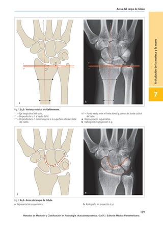 109
Arcos del carpo de Gilula
7
Articulacióndelamuñecaylamano
Fig. 7.3a,b Varianza cubital de Gelbermann.
1 = Eje longitudinal del radio.
1’ = Perpendicular a 1 a través de M.
1’’ = Perpendicular a 1 como tangente a la superficie articular distal
del cúbito.
M = Punto medio entre el límite dorsal y palmar del borde cubital
del radio.
a Representación esquemática.
b Radiografía en proyección d.-p.
Fig. 7.4a,b Arcos del carpo de Gilula.
a Representación esquemática. b Radiografía en proyección d.-p.
07-Articulación de la muñeca y la mano:Maquetación 1 04/06/13 12:35 Página 109
Métodos de Medición y Clasificación en Radiología Musculoesquelética. ©2013. Editorial Médica Panamericana.
 
