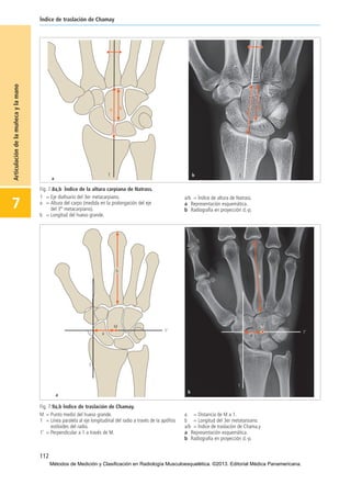 112
Índice de traslación de Chamay
7
Articulacióndelamuñecaylamano
Fig. 7.8a,b Índice de la altura carpiana de Natrass.
1 = Eje diafisario del 3er metacarpiano.
a = Altura del carpo (medida en la prolongación del eje
del 3er
metacarpiano).
b = Longitud del hueso grande.
a/b = Índice de altura de Natrass.
a Representación esquemática.
b Radiografía en proyección d.-p.
Fig. 7.9a,b Índice de traslación de Chamay.
M = Punto medio del hueso grande.
1 = Línea paralela al eje longitudinal del radio a través de la apófisis
estiloides del radio.
1’ = Perpendicular a 1 a través de M.
a = Distancia de M a 1.
b = Longitud del 3er metatarsiano.
a/b = Índice de traslación de Chama.y
a Representación esquemática.
b Radiografía en proyección d.-p.
07-Articulación de la muñeca y la mano:Maquetación 1 04/06/13 12:35 Página 112
Métodos de Medición y Clasificación en Radiología Musculoesquelética. ©2013. Editorial Médica Panamericana.
 