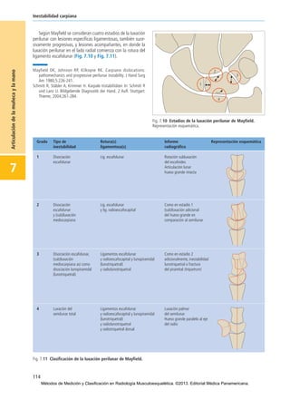 114
Inestabilidad carpiana
7
Articulacióndelamuñecaylamano
Según Mayfield se consideran cuatro estadios de la luxación
perilunar con lesiones específicas ligamentosas, también suce-
sivamente progresivas, y lesiones acompañantes, en donde la
luxación perilunar en el lado radial comienza con la rotura del
ligamento escafolunar (Fig. 7.10 y Fig. 7.11).
━Mayfield DK, Johnson RP, Kilkoyne RK. Carpiano dislocations:
pathomechanics and progressive perilunar instability. J Hand Surg
Am 1980;5:226-241.
Schmitt R, Stäbler A, Krimmer H. Karpale Instabilitäten In: Schmitt R
und Lanz U. Bildgebende Diagnostik der Hand. 2 Aufl. Stuttgart:
Thieme; 2004;261-284.
Fig. 7.10 Estadios de la luxación perilunar de Mayfield.
Representación esquemática.
Fig. 7.11 Clasificación de la luxación perilunar de Mayfield.
07-Articulación de la muñeca y la mano:Maquetación 1 04/06/13 12:35 Página 114
Métodos de Medición y Clasificación en Radiología Musculoesquelética. ©2013. Editorial Médica Panamericana.
 