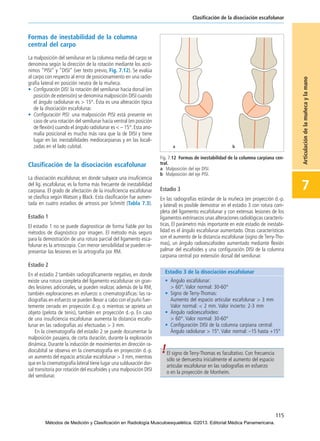 Formas de inestabilidad de la columna
central del carpo
La malposición del semilunar en la columna media del carpo se
denomina según la dirección de la rotación mediante los acró-
nimos “PISI” y “DISI” (ver texto previo, Fig. 7.12). Se evalúa
al carpo con respecto al error de posicionamiento en una radio-
grafía lateral en posición neutra de la muñeca.
• Configuración DISI: la rotación del semilunar hacia dorsal (en
posición de extensión) se denomina malposición DISI cuando
el ángulo radiolunar es > 15°. Ésta es una alteración típica
de la disociación escafolunar.
• Configuración PISI: una malposición PISI está presente en
caso de una rotación del semilunar hacia ventral (en posición
de flexión) cuando el ángulo radiolunar es < – 15°.Esta ano-
malía posicional es mucho más rara que la de DISI y tiene
lugar en las inestabilidades mediocarpianas y en las locali-
zadas en el lado cubital.
Clasificación de la disociación escafolunar
La disociación escafolunar, en donde subyace una insuficiencia
del lig. escafolunar, es la forma más frecuente de inestabilidad
carpiana. El grado de afectación de la insuficiencia escafolunar
se clasifica según Watson y Black. Esta clasificación fue aumen-
tada en cuatro estadios de artrosis por Schmitt (Tabla 7.3).
Estadio 1
El estadio 1 no se puede diagnosticar de forma fiable por los
métodos de diagnóstico por imagen. El método más seguro
para la demostración de una rotura parcial del ligamento esca-
folunar es la artroscopia. Con menor sensibilidad se pueden re-
presentar las lesiones en la artrografía por RM.
Estadio 2
En el estadio 2 también radiográficamente negativo, en donde
existe una rotura completa del ligamento escafolunar sin gran-
des lesiones adicionales, se pueden realizar, además de la RM,
también exploraciones en esfuerzo o cinematográficas: las ra-
diografías en esfuerzo se pueden llevar a cabo con el puño fuer-
temente cerrado en proyección d.-p. o mientras se aprieta un
objeto (pelota de tenis), también en proyección d.-p. En caso
de una insuficiencia escafolunar aumenta la distancia escafo-
lunar en las radiografías así efectuadas > 3 mm.
En la cinematografía del estadio 2 se puede documentar la
malposición pasajera, de corta duración, durante la exploración
dinámica. Durante la inducción de movimientos en dirección ra-
diocubital se observa en la cinematografía en proyección d.-p.
un aumento del espacio articular escafolunar > 3 mm, mientras
que en la cinematografía lateral tiene lugar una subluxación dor-
sal transitoria por rotación del escafoides y una malposición DISI
del semilunar.
Estadio 3
En las radiografías estándar de la muñeca (en proyección d.-p.
y lateral) es posible demostrar en el estadio 3 con rotura com-
pleta del ligamento escafolunar y con extensas lesiones de los
ligamentos extrínsecos unas alteraciones radiológicas caracterís-
ticas. El parámetro más importante en este estadio de inestabi-
lidad es el ángulo escafolunar aumentado. Otras características
son el aumento de la distancia escafolunar (signo de Terry-Tho-
mas), un ángulo radioescafoideo aumentado mediante flexión
palmar del escafoides y una configuración DISI de la columna
carpiana central por extensión dorsal del semilunar.
115
Clasificación de la disociación escafolunar
7
Articulacióndelamuñecaylamano
Fig. 7.12 Formas de inestabilidad de la columna carpiana cen-
tral.
a Malposición del eje DISI.
b Malposición del eje PISI.
Estadio 3 de la disociación escafolunar
• Ángulo escafolunar:
> 60°. Valor normal: 30-60°
• Signo de Terry-Thomas:
Aumento del espacio articular escafolunar > 3 mm
Valor normal: < 2 mm. Valor incierto: 2-3 mm
• Ángulo radioescafoideo:
> 60°. Valor normal: 30-60°
• Configuración DISI de la columna carpiana central:
Ángulo radiolunar > 15°. Valor normal: –15 hasta +15°
El signo de Terry-Thomas es facultativo. Con frecuencia
sólo se demuestra inicialmente el aumento del espacio
articular escafolunar en las radiografías en esfuerzo
o en la proyección de Monheim.
07-Articulación de la muñeca y la mano:Maquetación 1 04/06/13 12:35 Página 115
Métodos de Medición y Clasificación en Radiología Musculoesquelética. ©2013. Editorial Médica Panamericana.
 