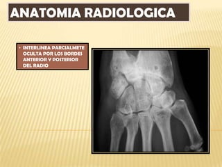 ANATOMIA RADIOLOGICA

 • INTERLINEA PARCIALMETE
   OCULTA POR LOS BORDES
   ANTERIOR Y POSTERIOR
   DEL RADIO
 