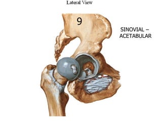 9
    SINOVIAL –
    ACETABULAR
 