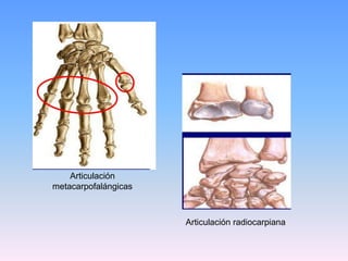 Articulación
metacarpofalángicas



                      Articulación radiocarpiana
 
