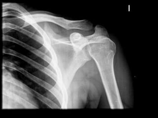 Articulacionradiocubital proximal