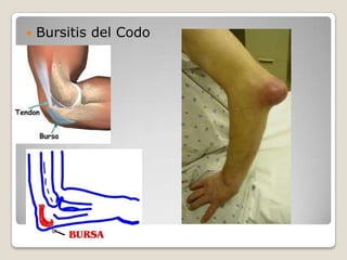 LUXACION DE LA ARTICULACION ESTERNOCAVICULARANQUILOSIS DE LA ARTICULACION ESTERNOCLAVICULAR