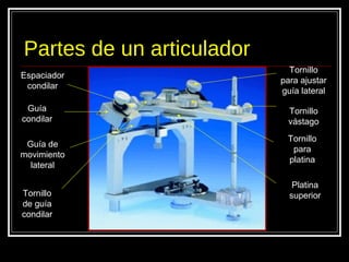 Partes de un articulador
Guía
condilar
Guía de
movimiento
lateral
Espaciador
condilar
Tornillo
vástago
Tornillo
para
platina
Platina
superiorTornillo
de guía
condilar
Tornillo
para ajustar
guía lateral
 