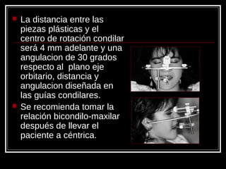  La distancia entre las
piezas plásticas y el
centro de rotación condilar
será 4 mm adelante y una
angulacion de 30 grados
respecto al plano eje
orbitario, distancia y
angulacion diseñada en
las guías condilares.
 Se recomienda tomar la
relación bicondilo-maxilar
después de llevar el
paciente a céntrica.
 