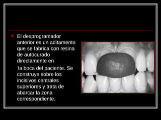  El desprogramador
anterior es un aditamento
que se fabrica con resina
de autocurado
directamente en
la boca del paciente. Se
construye sobre los
incisivos centrales
superiores y trata de
abarcar la zona
correspondiente.
 