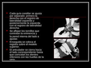  Cada guía condilar se ajusta
por separado: primero la
derecha con el registro de
lateralidad izquierda y
posteriormente la izquierda
con el registro de lateralidad
derecha.
 Se aflojan los tornillos que
controlan la eminencia y
la pared interna del lado a
ajustar.
 Enseguida se coloca el
registro sobre el modelo
superior.
 El articulador se cierra hacia
el lado correspondiente hasta
que coincidan los dientes
inferiores con las huellas de la
cera .
 
