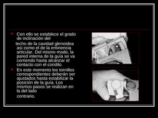  Con ello se establece el grado
de inclinación del
techo de la cavidad glenoidea
así como el de la eminencia
articular. Del mismo modo, la
pared interna de la guía se va
corriendo hasta alcanzar el
contacto con el condilo.
 En este momento los tornillos
correspondientes deberán ser
ajustados hasta estabilizar la
posición de la guía. Los
mismos pasos se realizan en
la del lado
contrario.
 