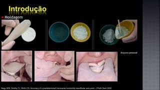 Nagy WW, Smithy TJ, Wirth CG. Accuracy of a predetermined transverse horizontal mandibular axis point. J Prsth Dent 2002
Moldagem
Arquivo pessoal
 