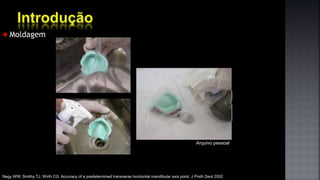 Moldagem
Arquivo pessoal
Nagy WW, Smithy TJ, Wirth CG. Accuracy of a predetermined transverse horizontal mandibular axis point. J Prsth Dent 2002
 