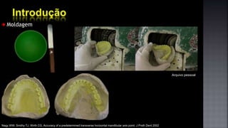 Moldagem
Arquivo pessoal
Nagy WW, Smithy TJ, Wirth CG. Accuracy of a predetermined transverse horizontal mandibular axis point. J Prsth Dent 2002
 