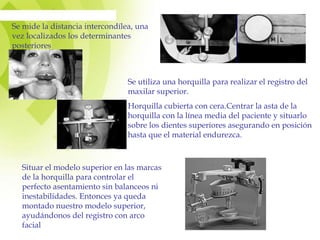 Se mide la distancia intercondílea, una
vez localizados los determinantes
posteriores
Se utiliza una horquilla para realizar el registro del
maxilar superior.
Horquilla cubierta con cera.Centrar la asta de la
horquilla con la línea media del paciente y situarlo
sobre los dientes superiores asegurando en posición
hasta que el material endurezca.
Situar el modelo superior en las marcas
de la horquilla para controlar el
perfecto asentamiento sin balanceos ni
inestabilidades. Entonces ya queda
montado nuestro modelo superior,
ayudándonos del registro con arco
facial
 