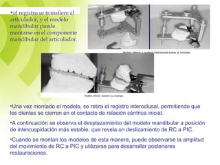 •el registro se transfiere al
articulador, y el modelo
mandibular puede
montarse en el componente
mandibular del articulador.
•Una vez montado el modelo, se retira el registro interoclusal, permitiendo que
los dientes se cierren en el contacto de relación céntrica inicial.
•A continuación se observa el desplazamiento del modelo mandibular a posición
de intercuspidación más estable, que revela un deslizamiento de RC a PIC.
•Cuando se montan los modelos de esta manera, puede observarse la amplitud
del movimiento de RC a PIC y utilizarse para desarrollar posteriores
restauraciones.
 