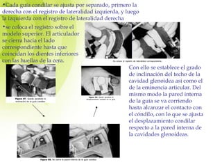 •Cada guía condilar se ajusta por separado, primero la
derecha con el registro de lateralidad izquierda, y luego
la izquierda con el registro de lateralidad derecha
•se coloca el registro sobre el
modelo superior. El articulador
se cierra hacia el lado
correspondiente hasta que
coincidan los dientes inferiores
con las huellas de la cera.
Con ello se establece el grado
de inclinación del techo de la
cavidad glenoidea así como el
de la eminencia articular. Del
mismo modo la pared interna
de la guía se va corriendo
hasta alcanzar el contacto con
el cóndilo, con lo que se ajusta
el desplazamiento condilar
respecto a la pared interna de
la cavidades glenoideas.
 