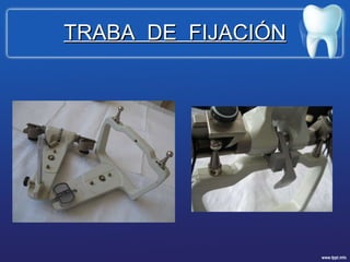 TRABA  DE  FIJACIÓN 